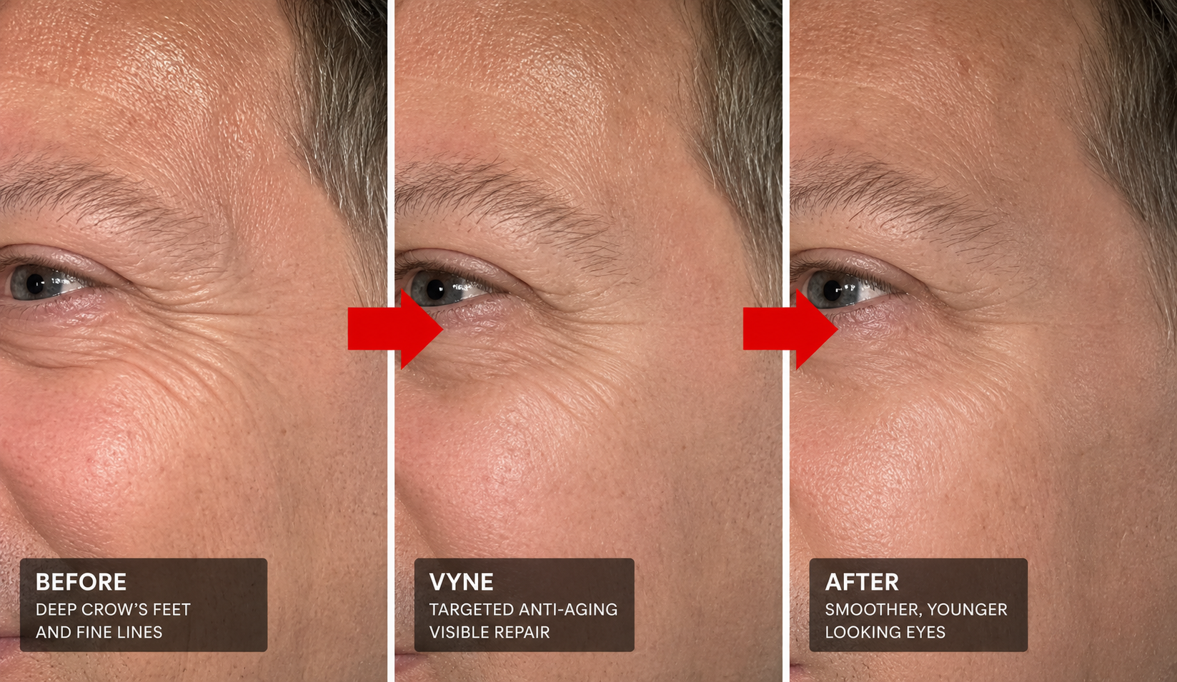 Before and after VYNE eye-area progression for James