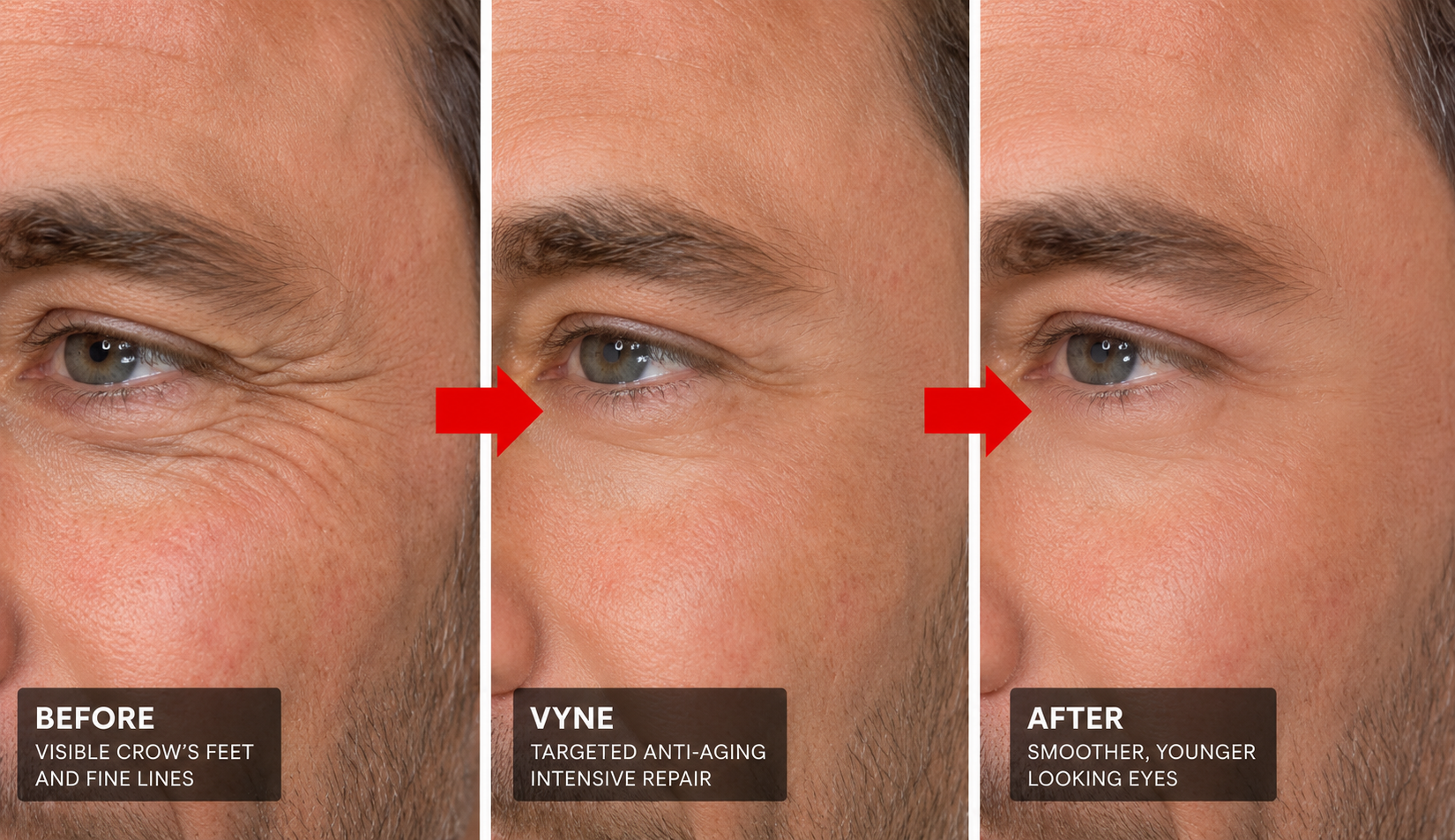 Before and after view showing smoother-looking eye area after VYNE