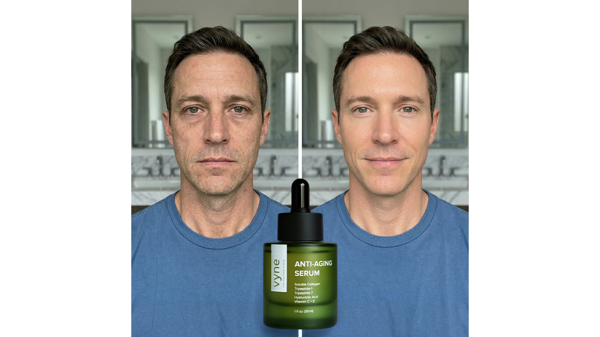 Before and after VYNE eye-area progression for Daniel